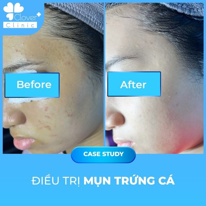 Clover Clinic & Spa – Phòng Khám Da Liễu Thẩm Mỹ Uy Tín Tại Quận 11